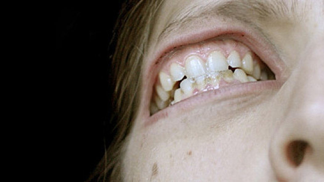 metastazis-eye-teeth-thumbnail