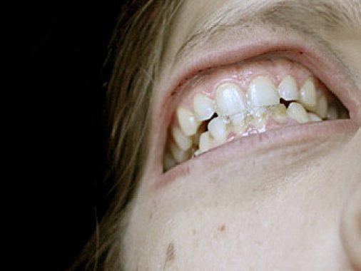 metastazis-eye-teeth-thumbnail